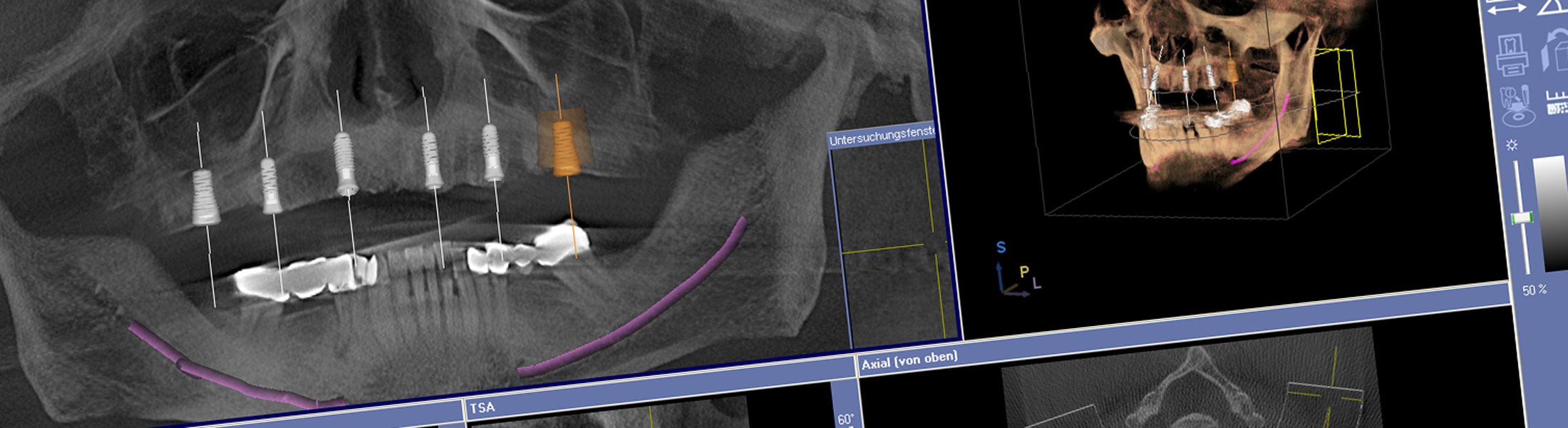 Navigierte Implantologie Köln