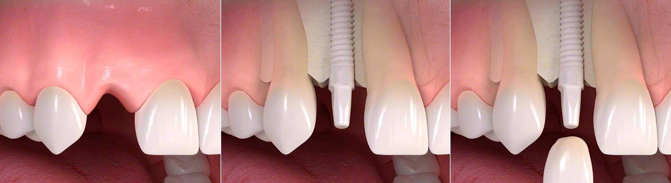 Keramik Implantate in Köln